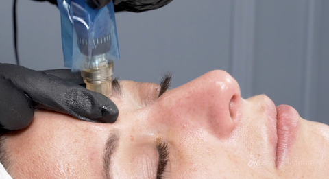 microneedling being performed on a woman's forehead