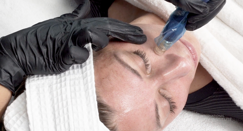 microneedling being performed on a woman's cheek