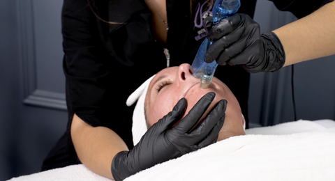 microneedling being performed on a woman's chin