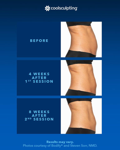 before and after comparison of coolsculpting a stomach