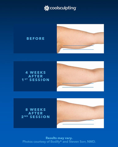 before and after comparison of coolsculpting an upper arm