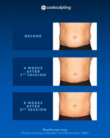 before and after comparison of coolsculpting a stomach