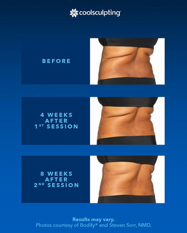 before and after comparison of coolsculpting a back